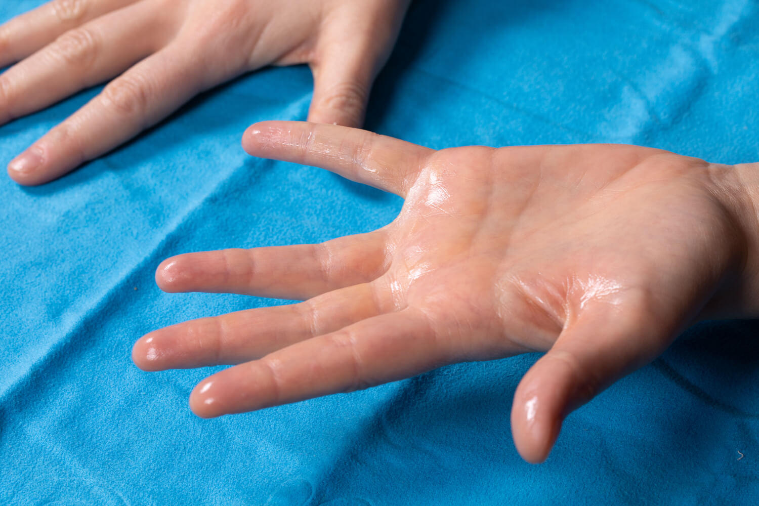 woman with excessively sweaty hands from hyperhidrosis receiving treatment at Garza Plastic Surgery