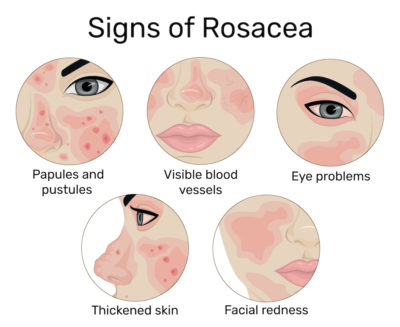rosacea signs nashville tn