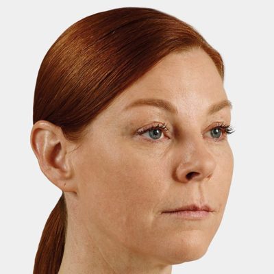 Middle aged woman with red hair showing results of Juvederm treatment. Juvederm is a non-surgical cosmetic injectable derma filler that restores youthful texture to your face.
