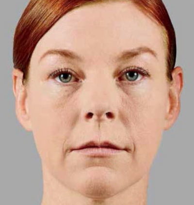 Image of a woman with red hair before getting Voluma facial treatment. Voluma is an injectable derma filler that improves mid-facial volume.