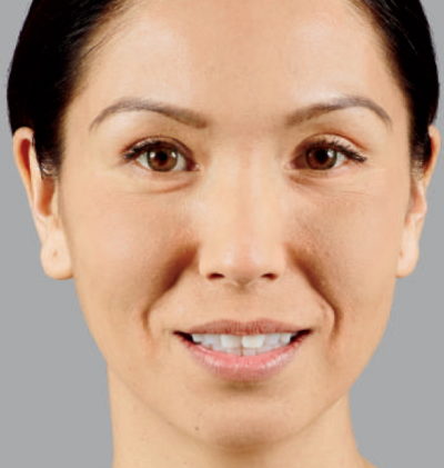 Woman smiling before getting Voluma derma filler face treatment to prevent volume loss in her mid-facial region.
