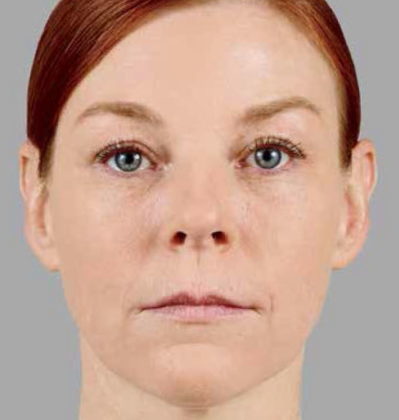 a woman with red hair after getting Voluma to improve the volume and texture of her mid-facial region. Skin under the eyes is lighter and has a more youthful appearance.