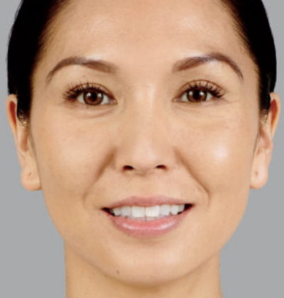 woman after receiving voluma injectable dermal filler at Garza Plastic Surgery to restore midfacial volume