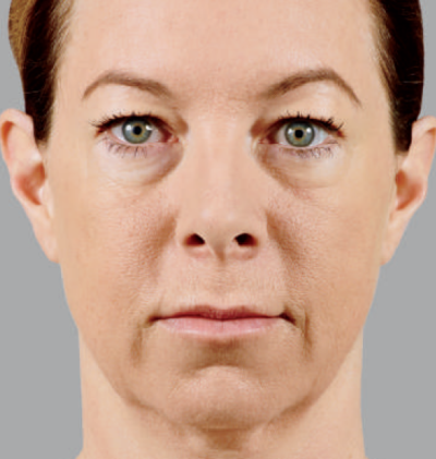 Picture of a middle aged woman before Voluma dermal filler treatment. Voluma is used to prevent or reduce mid-facial volume loss.