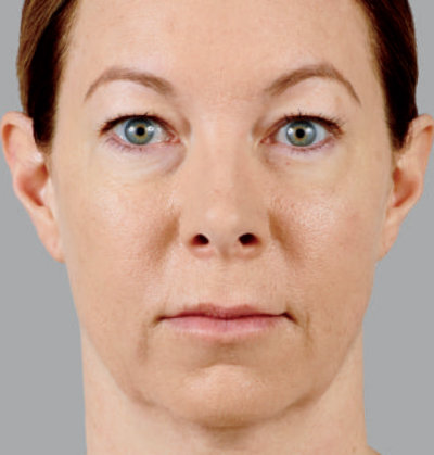 Image of a middle age woman after receiving Voluma treatment to prevent mid-face volume loss. Shows improved skin texture and volume, younger looking skin, and reduced bags under the eyes.