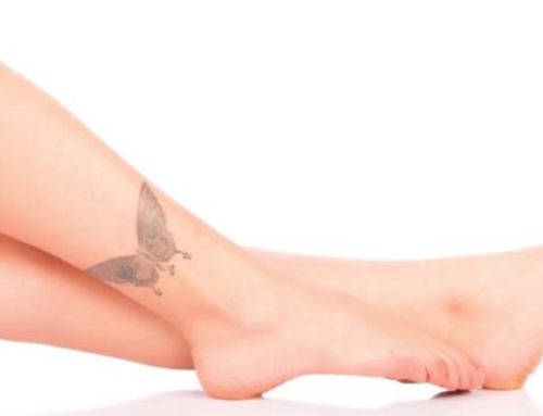 The Ins and Outs of Laser Tattoo Removal