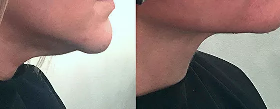 Chin Before/After