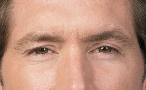 Image showing middle aged man's results from facial wrinkle reduction treatments.