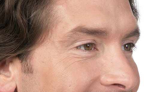 picture of a middle aged man showing the results of wrinkle reduction cosmetic treatments.