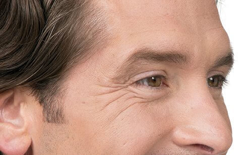 Side profile shot of a man's face showing wrinkles around his eyes before having cosmetic wrinkle reduction treatments