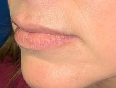 Close up of a patient's lips before Volbella injectable fillers are added to give the lips more volume.