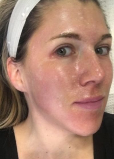 Picture of a young woman with ZO Skin Health products applied to her face.