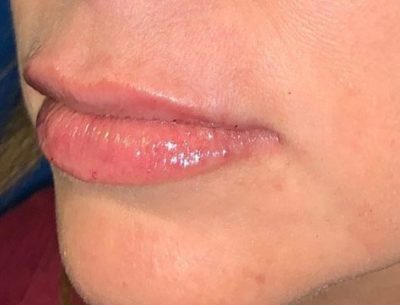 After image. Results for Volbella injectable derma filler for the lips. Close up image shows the subtle lift and boost to texture.