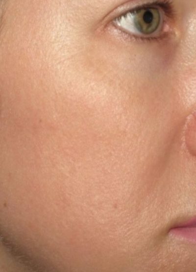 Close up picture of a woman's face before using ZO Skin Health skincare products to take care of her skin and maintain her youthful appearance.