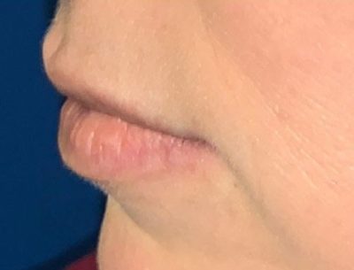 Close up photo of a patients lips before adding texture and volume with Volbella injectable derma filler.