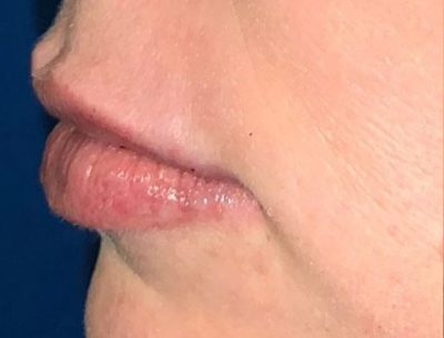 A close up picture of a patient's lips after Volbella injectable derma filler treatment. Volume added to the upper and lower lips for a more attractive look.