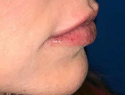 Close up picture of a patient's lips after receiving Volbella treatment. The lips now have a fuller and younger look.
