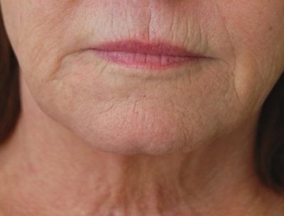 close up front view of a patient before receiving Kybella injectable cosmetic treatment to reduce sub mental fullness, better known as double chin, and improve facial definition.
