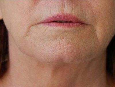 Close up picture of a woman face and neck, showing improved jawline and reduced levels of fat from under her chin. Picture taken after Kybella injectable cosmetic treatment.