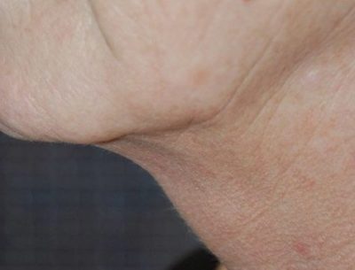 A close up of a patient's neck before Kybella treatment to reduce sub-mental fullness or double chin.