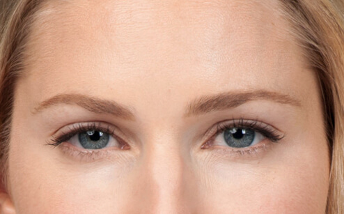 Front facial picture showing a woman's results after cosmetic facial treatment for aging skin.