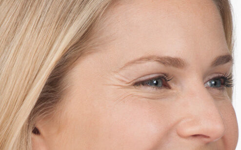 Side facial view of a woman showing wrinkles around the eyes before receiving cosmetic treatments