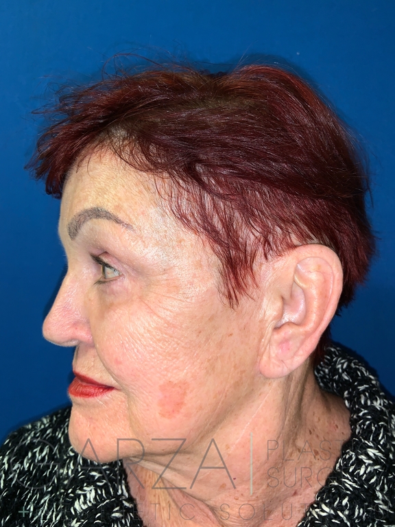 Left profile view of an older woman to show the results of blepharoplasty surgery on her face. Deep lines and bags under her eyes are basically gone, and the rest of her skin looks fuller and brighter.