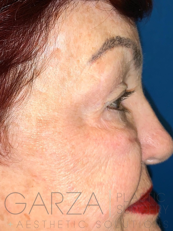 Close up, right side profile of an older woman before receiving blepharoplasty surgery to reduce lines and bags under her eyes.