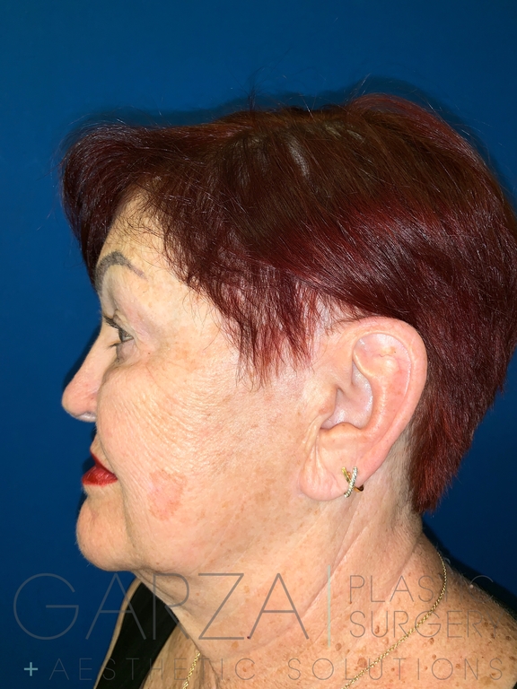 Left profile picture of an older woman before upper blepharoplasty treatment to reduce bags and lines under her eyes.