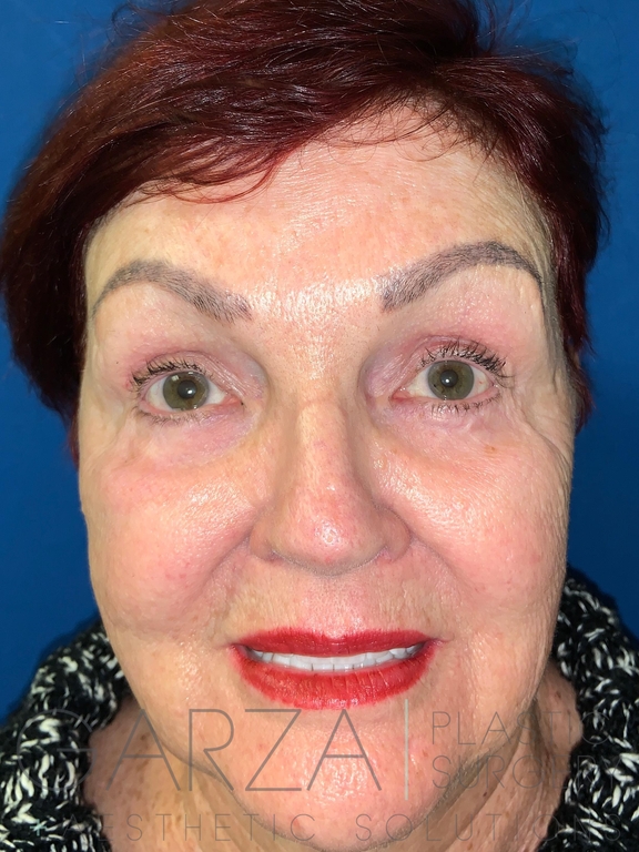 Image of an older woman after blepharoplasty treatment. She's smiling and happy that the lines and bags under her eyes are basically gone now.