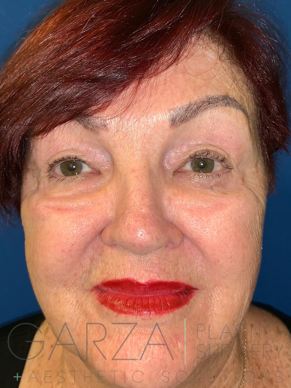 Image of an older woman before an upper blepharoplasty treatment to reduce lines and bags under her eyes.