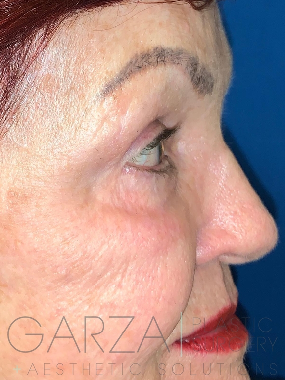 A close up picture of an older woman after receiving a blepharoplasty to reduce the puffy bags and lines under her eyes. The bags under her eyes are now gone.
