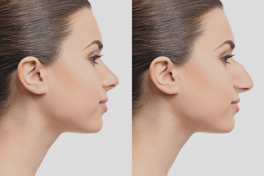 nose job at garza plastic surgery. get a nose job in nashville tennessee