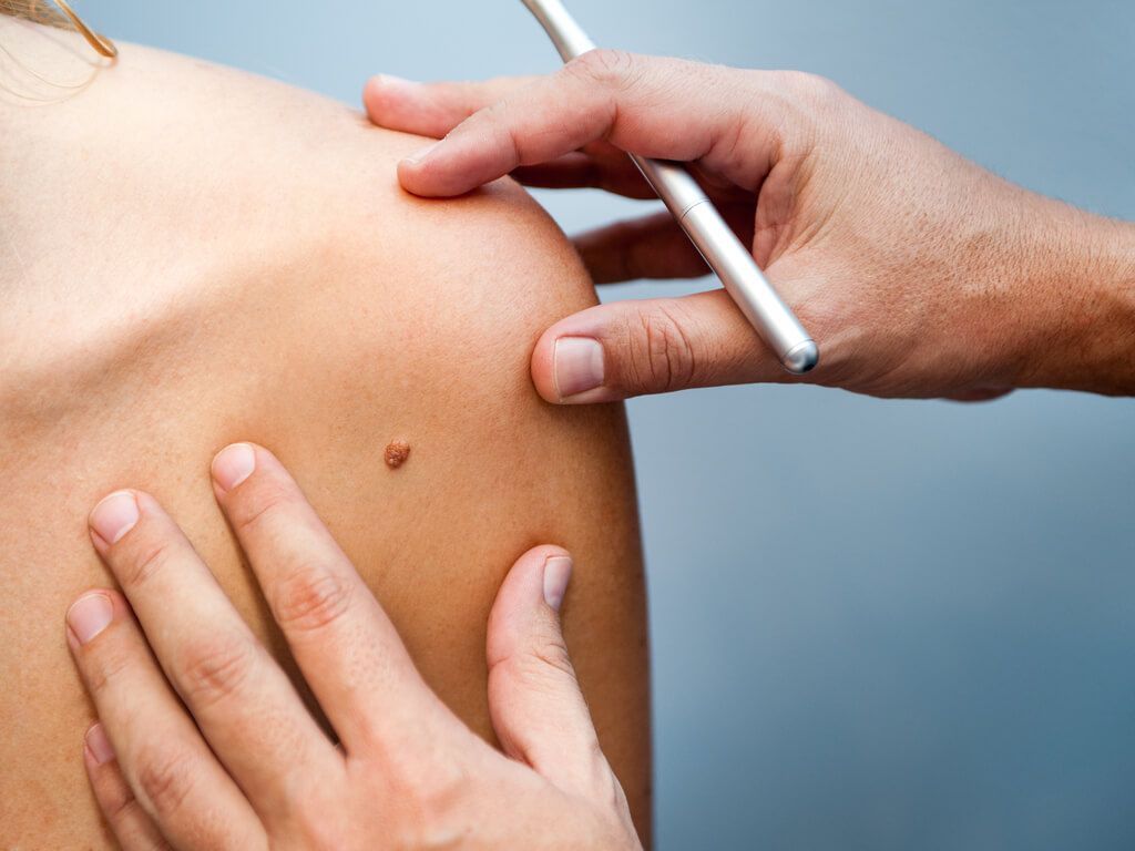 skin cancer treatments in nashville - precancerous mole removal