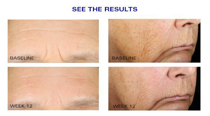 Results of ZO Skincare wrinkle and texture repair