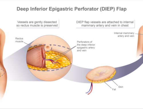 What’s the difference in TRAM or DIEP Flap surgery?