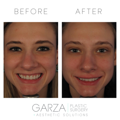 botox nashville before and after gummy smile