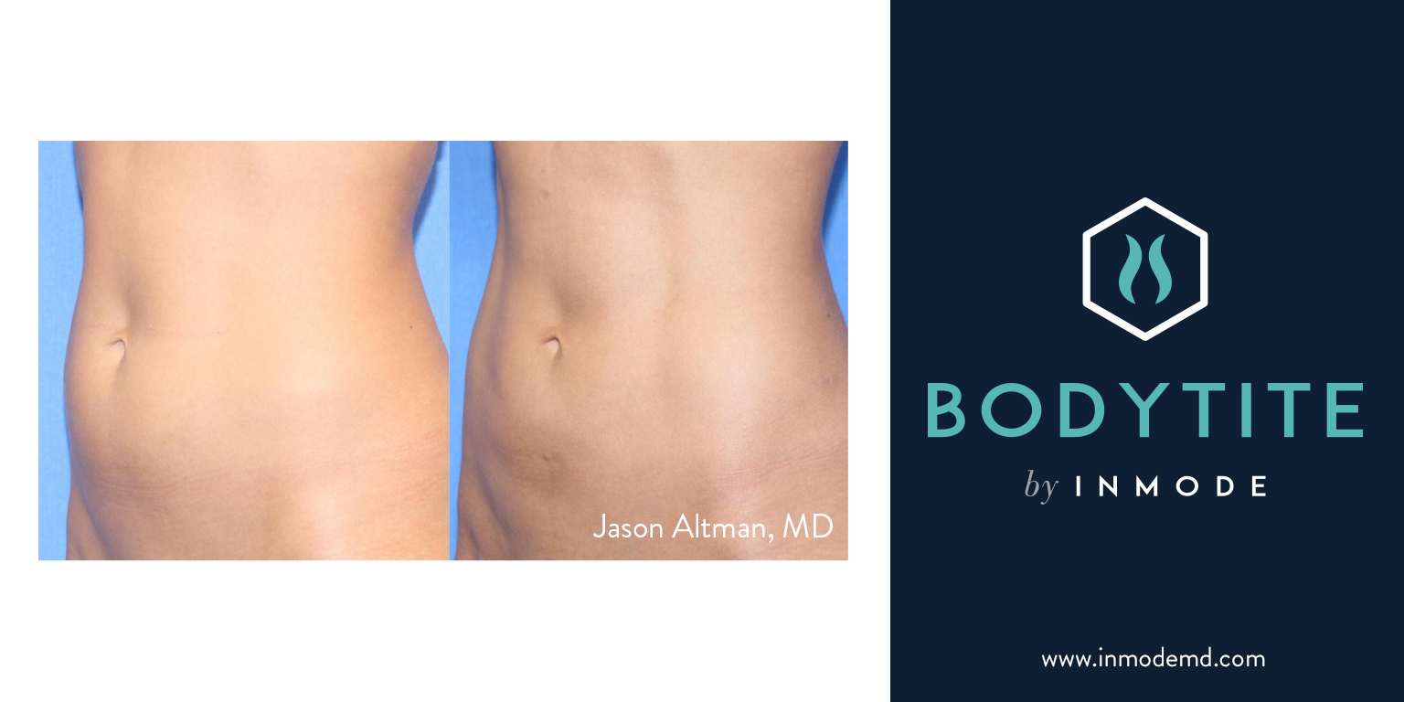 bodytite before and after body contouring nonsurgical fat removal nashville belle meade
