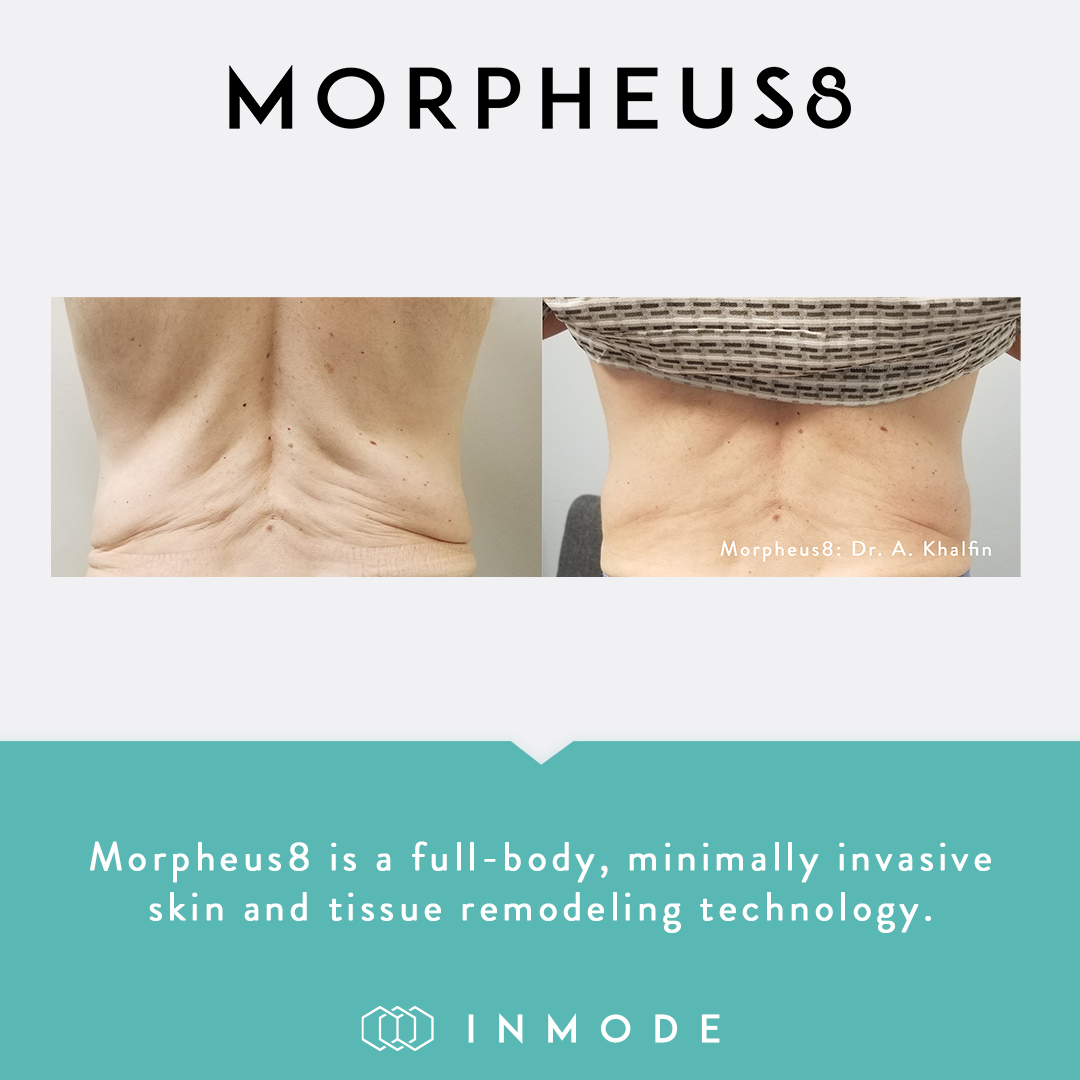 Morpheus8 nashville before and after skin tightening