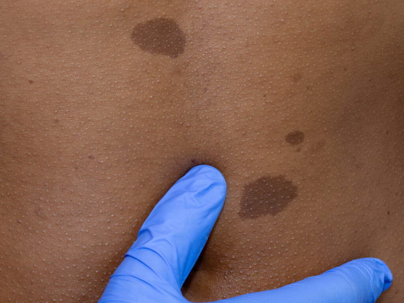 Get yearly skin cancer screenings from a TN plastic surgeon
