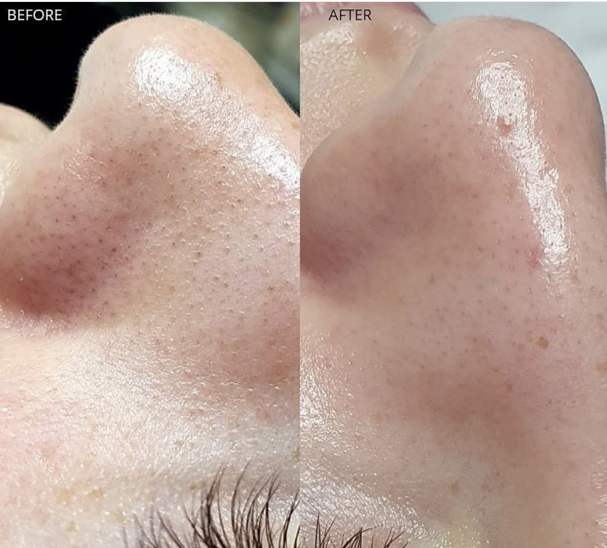 hydrafacial nashville belle meade before and after nose blackheads hydrafacial