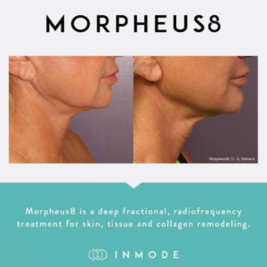 microneedling in nashville with morpheus8 best summer skin treatments