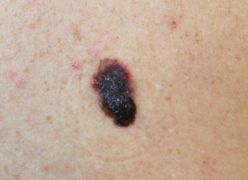Image of a dark mole that has been diagnosed as skin cancer