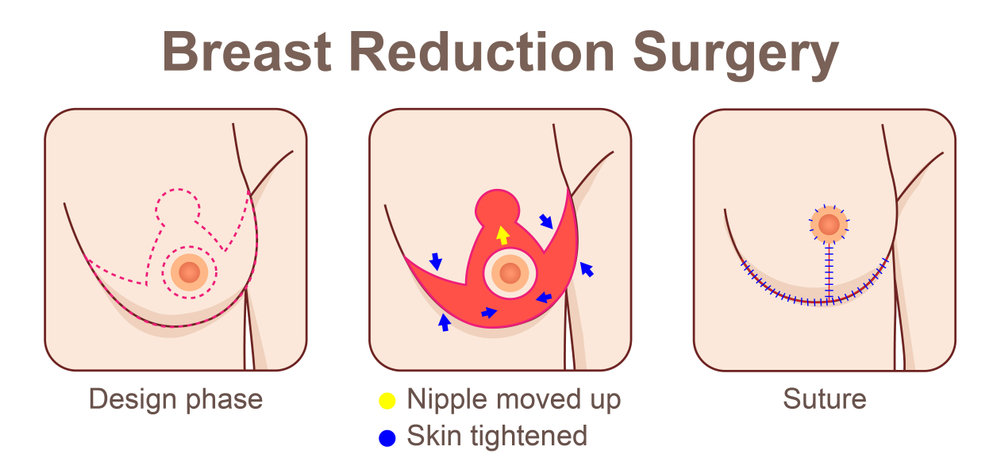 breast reduction surgery in nashville