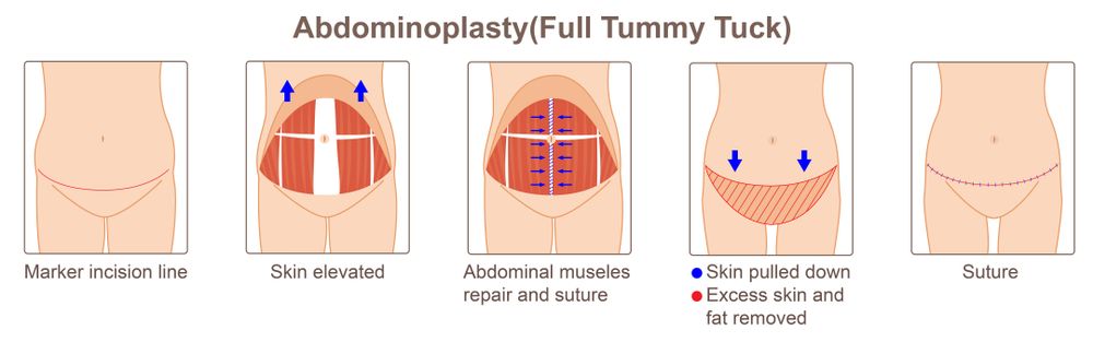 what is a tummy tuck