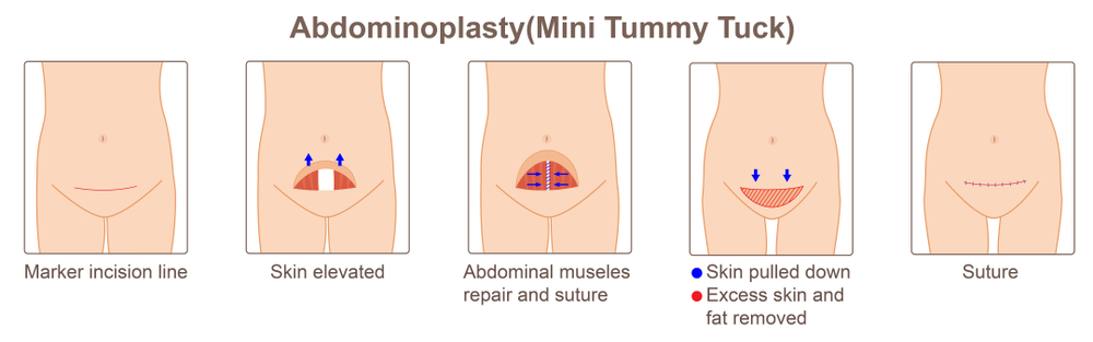 what is a mini tummy tuck
