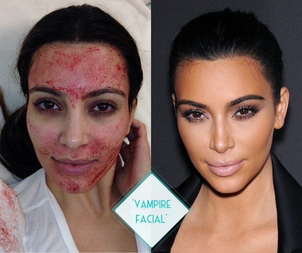A before and after comparison of Kim Kardashian's infamous vampire facial, also known as a prp facial. On the left is Kim's face immediately after her facial, where her face is bloody. On the right is a picture of Kim on the red carpet with a clear face and a glowing complexion.