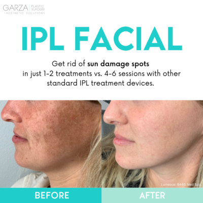 treat sun damage and age spots with lumecca IPL facial in nashville