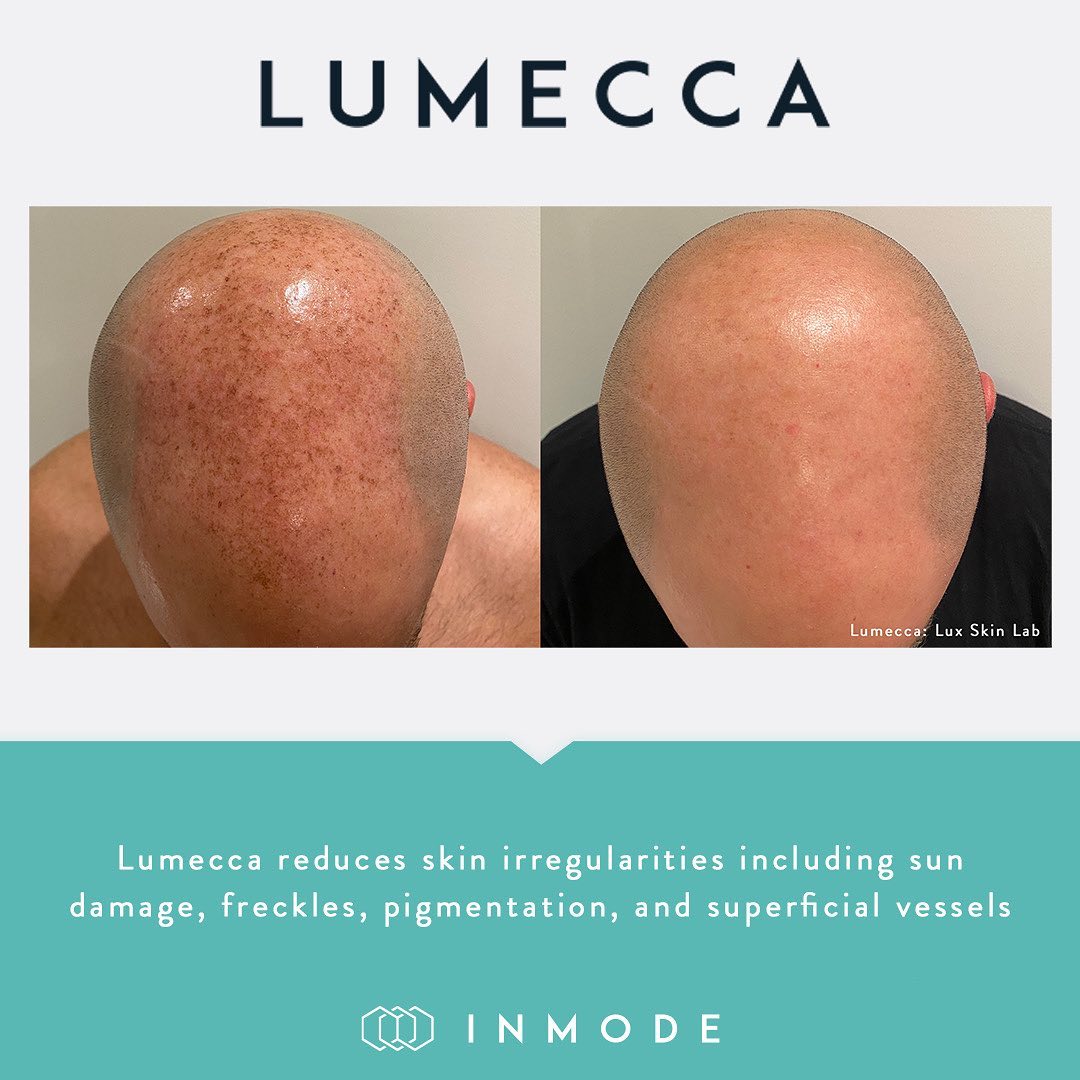 before and after lumecca IPL treatments on the scalp