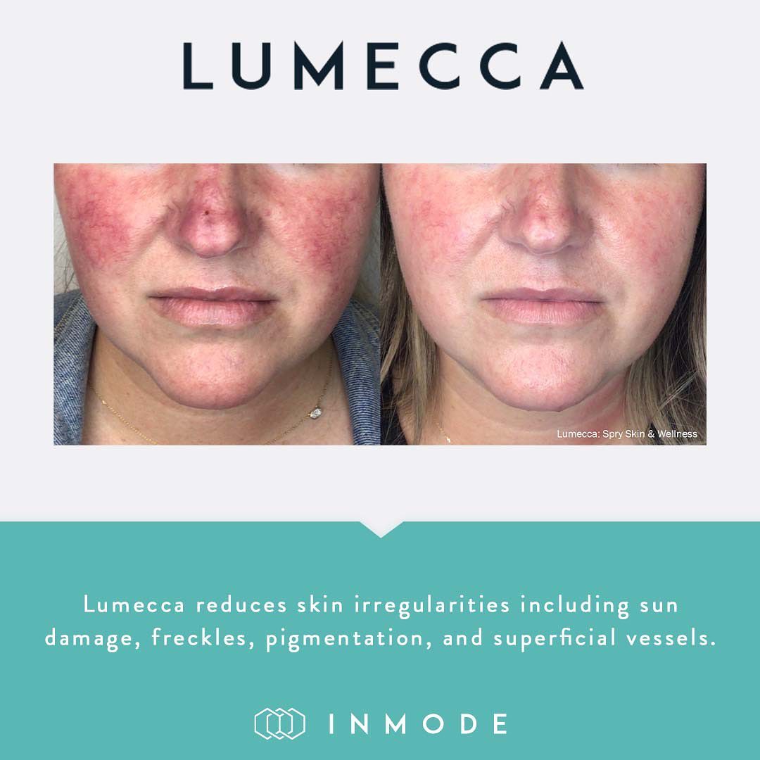 lumecca before and after in nashville